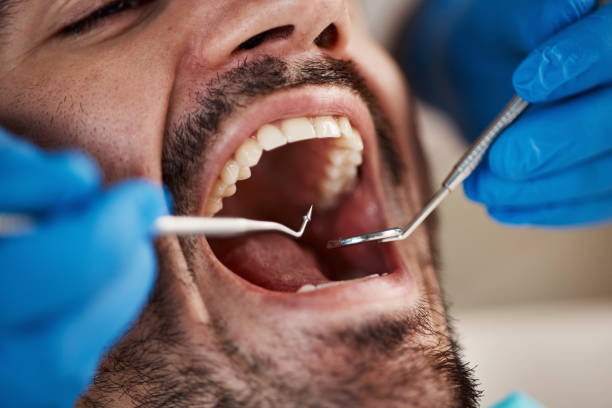 Best Emergency Wisdom Tooth Extraction in Linn, MO