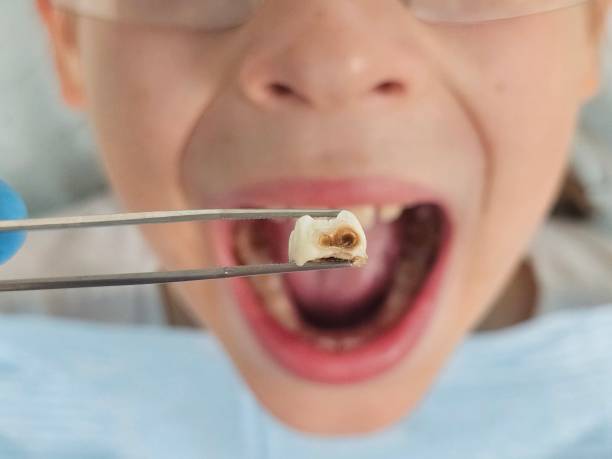 Best Emergency Treatment for Oral Infections in Linn, MO