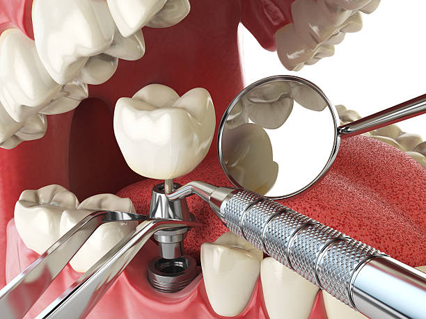 Best Emergency Cosmetic Dentistry (e.g., broken veneers) in Linn, MO